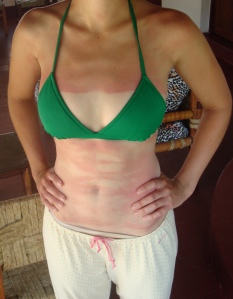 Paintbrush strokes of sunburn across Julie's stomach topped off with a lovely geometric sternum burn (and long pants hiding the offending legs)